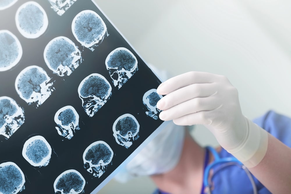 brain injury lawyer Lafayette, IN