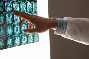 brain injury lawyer in Lafayette, IN